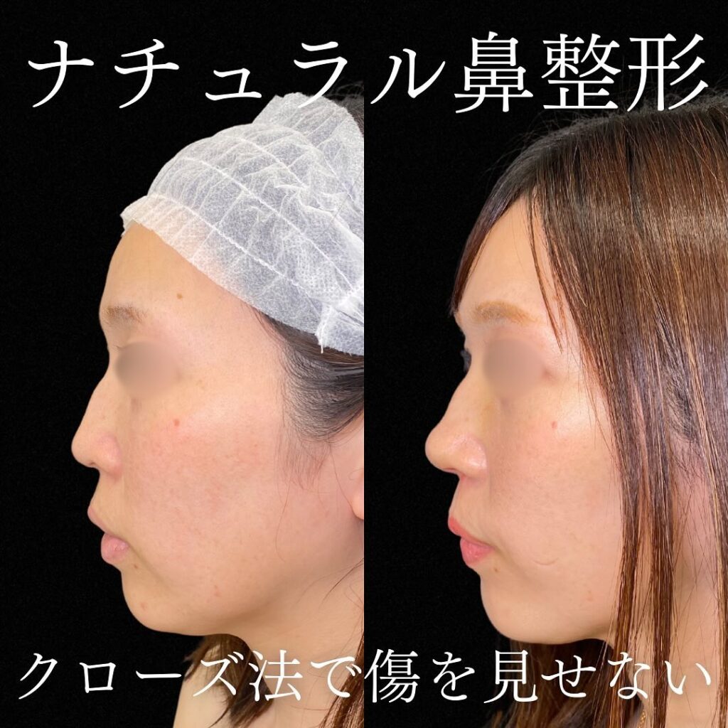 鼻尖形成クローズ法と耳介軟骨移植の症例写真