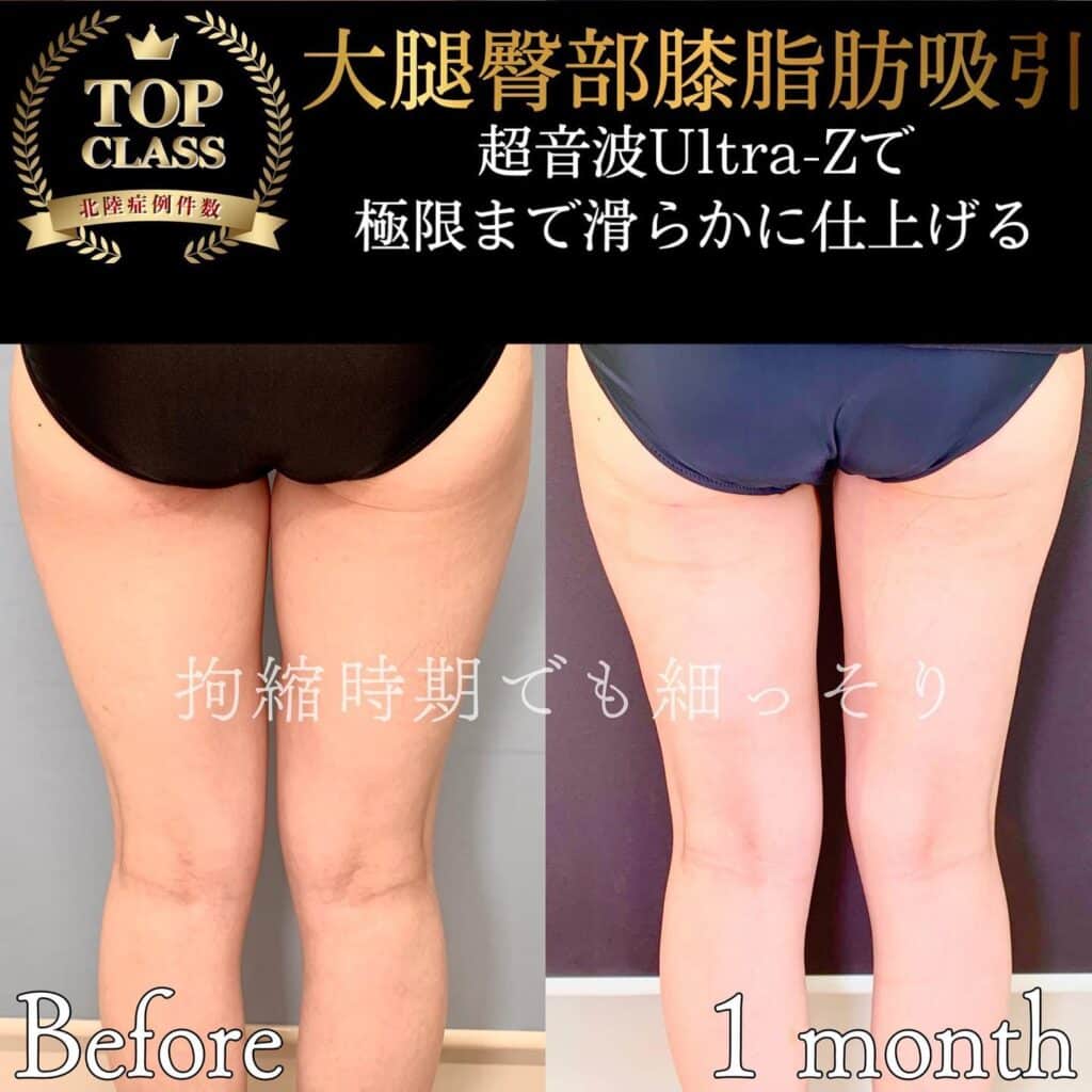 太ももの脂肪吸引の症例写真 (3)