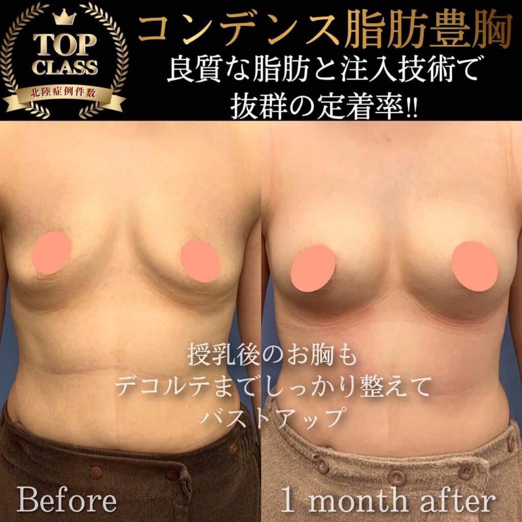 コンデンス脂肪豊胸の症例写真 (6)
