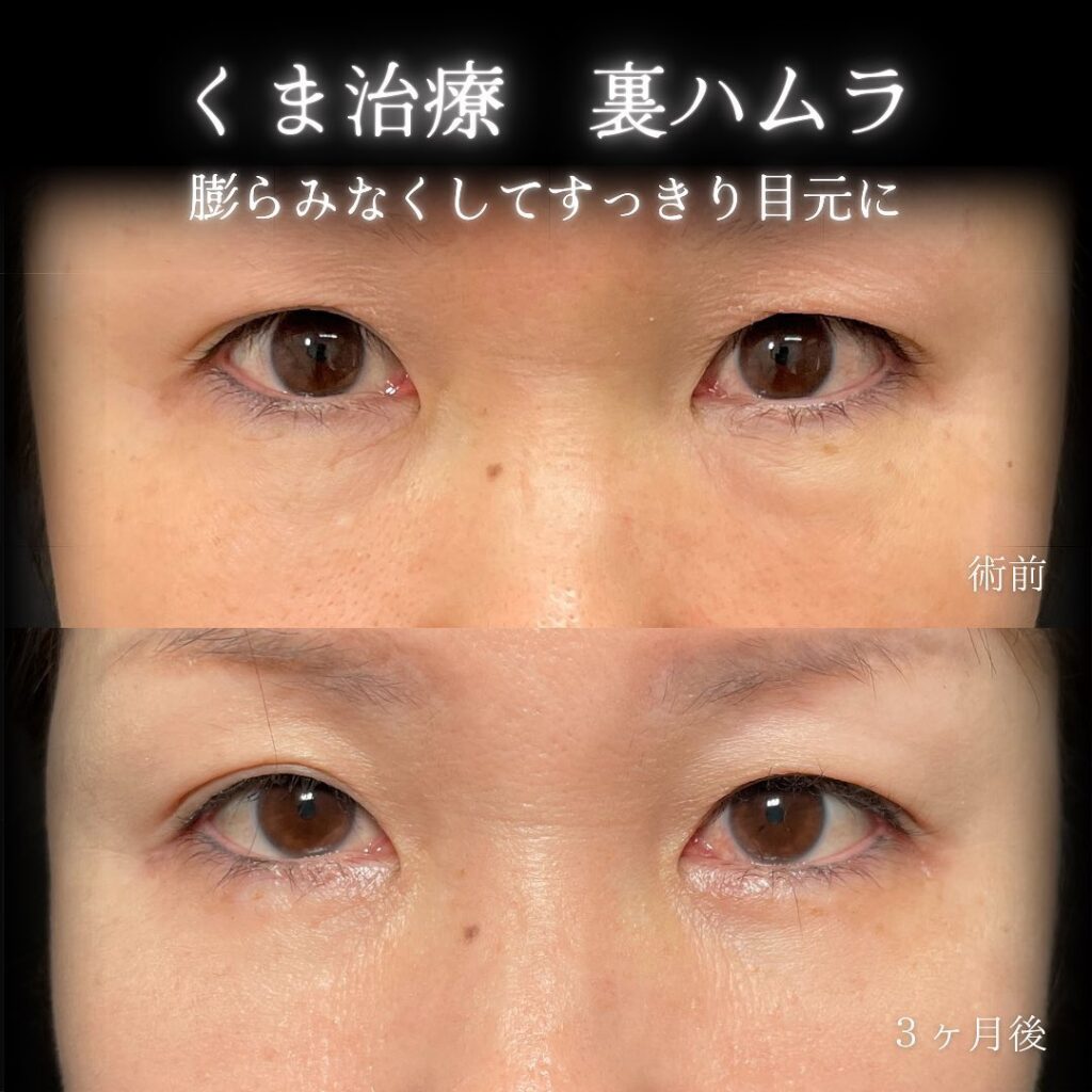 eクリニック大阪院の裏ハムラの症例画像（6）