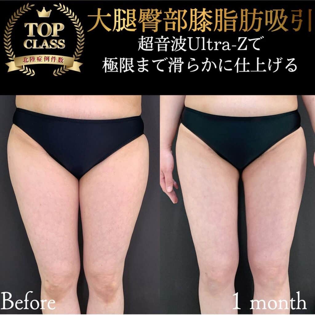 太ももの脂肪吸引の症例写真 (4)