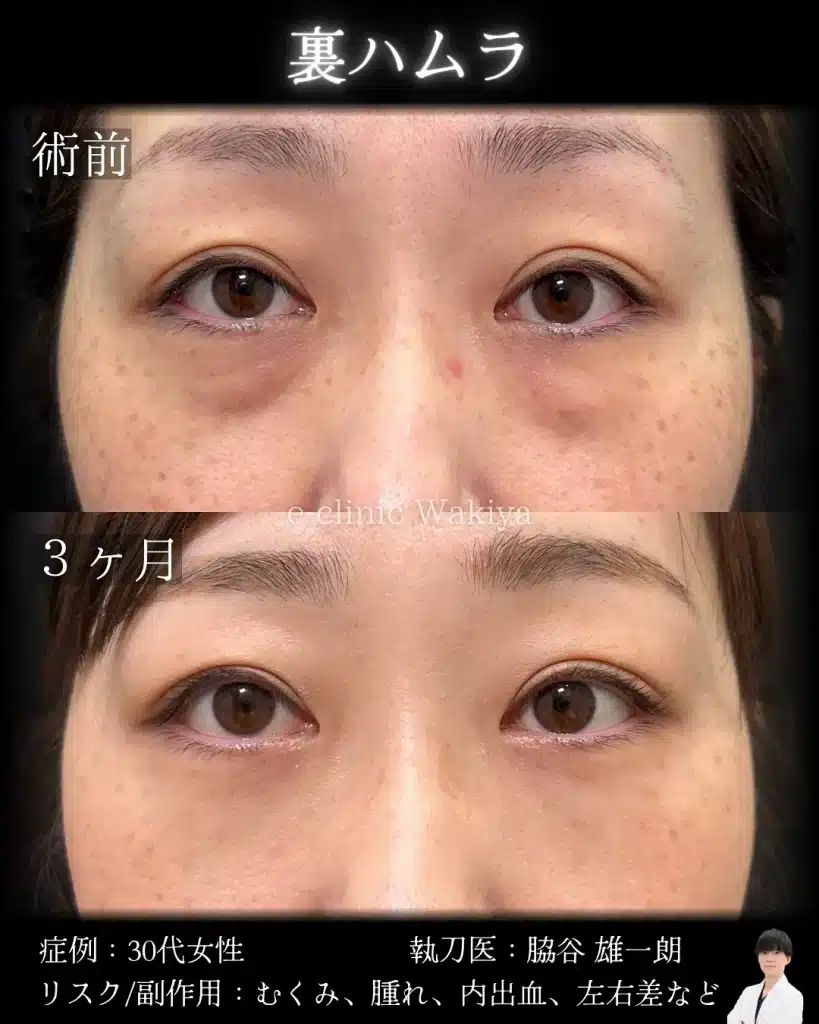 名医の脇谷雄一朗医師　裏ハムラ　クマ取り