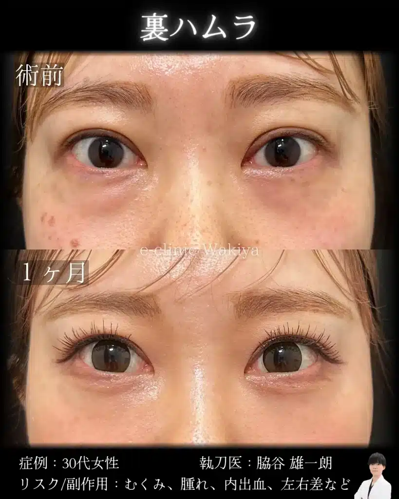 名医の脇谷雄一朗医師　裏ハムラ　クマ取り