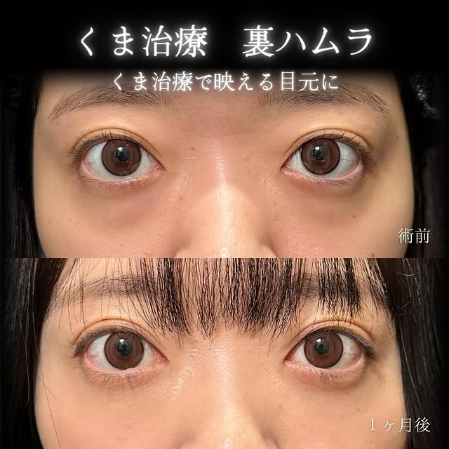 裏ハムラ法の症例写真 (24)