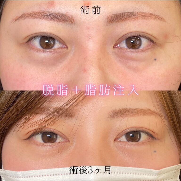 eクリニック大阪院の経結膜脱脂の症例写真(5)
