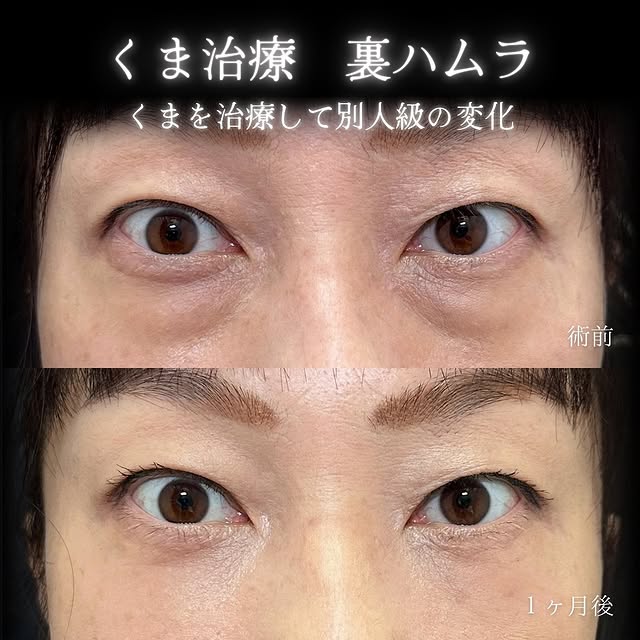 裏ハムラ法の症例写真 (21)