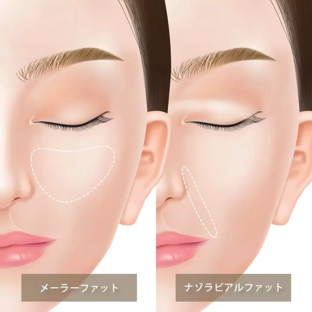 ナゾラビアルファット除去の図解