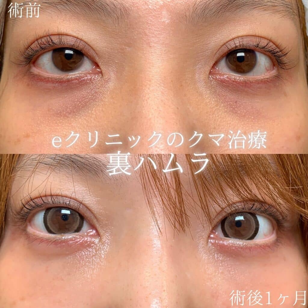 eクリニック大阪院の裏ハムラの症例画像（1）