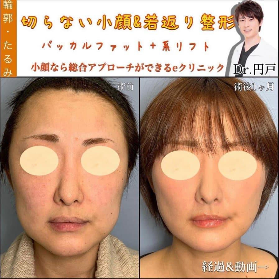 糸リフト バッカルファット
