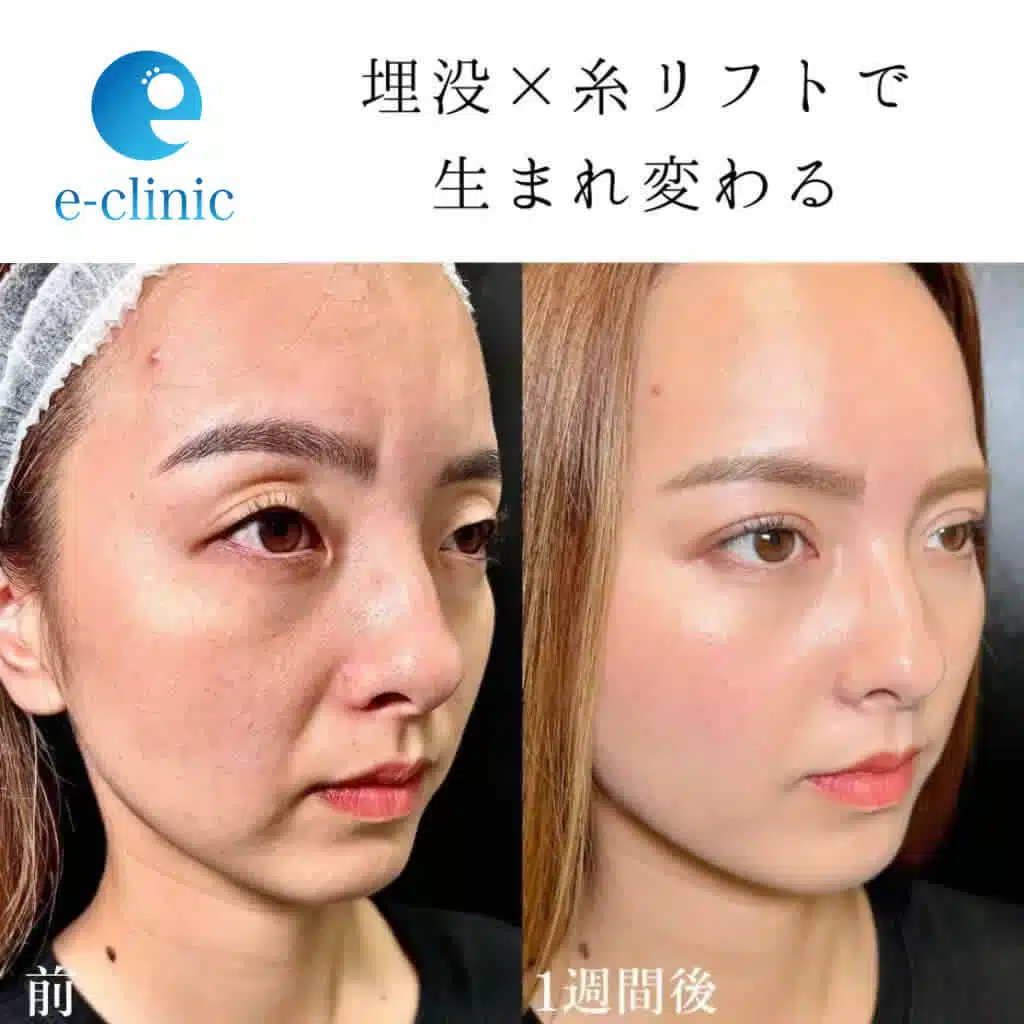 糸リフト