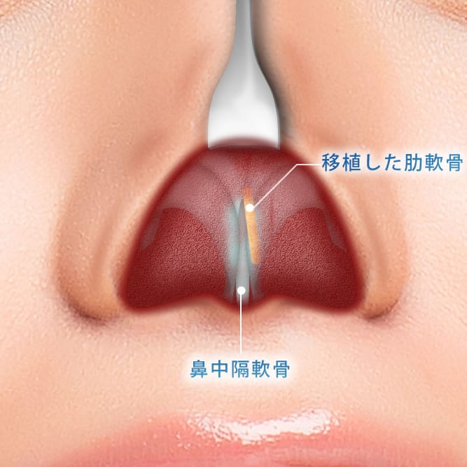 肋軟骨移植の鼻の中の解剖図