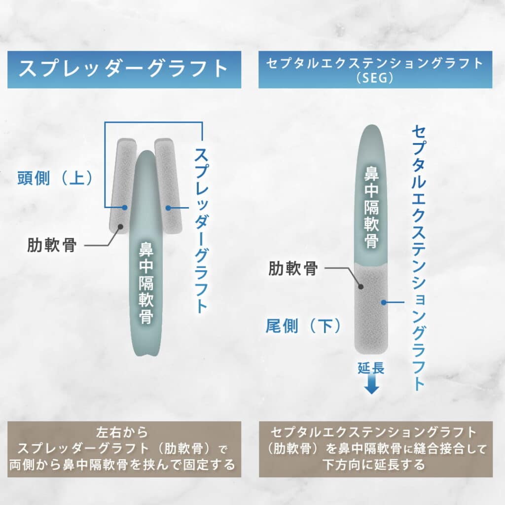 スプレッダーグラフトとセプタルエクステンショングラフトの違い
