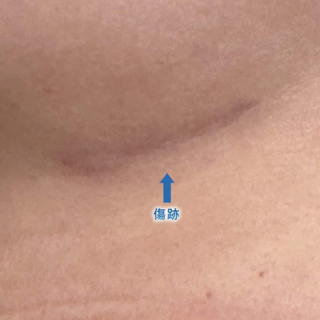 ６ヶ月後の肋軟骨の採取部分の傷跡