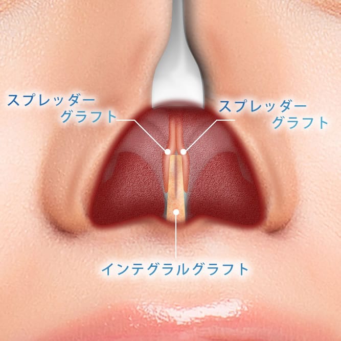 肋軟骨移植でスプレッダーグラフとインテグラルグラフトを併用した解剖図