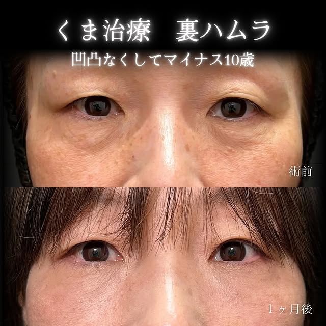 裏ハムラ法の症例写真 (12)