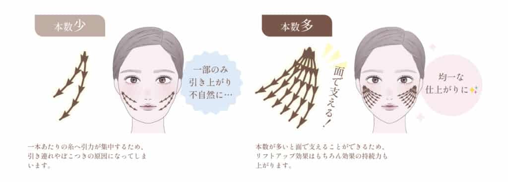 糸リフト