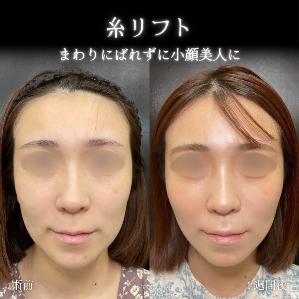 糸リフト