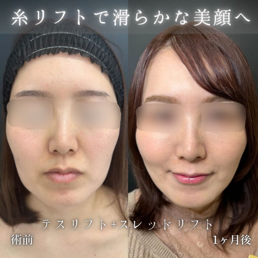 糸リフト