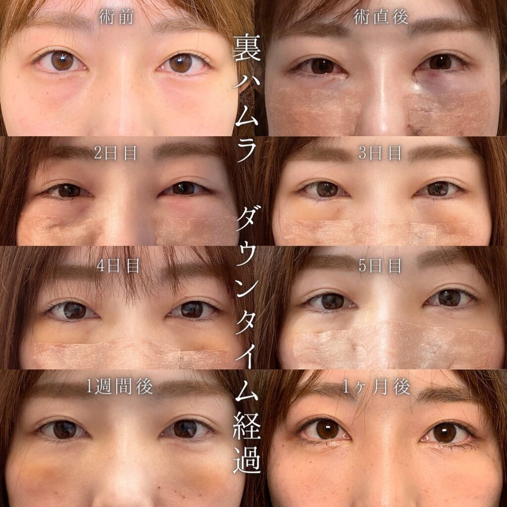 裏ハムラの経過