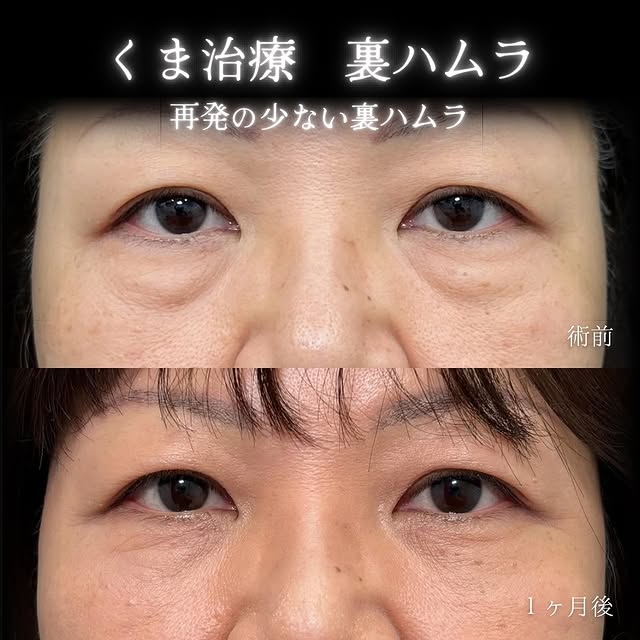 裏ハムラ法の症例写真 (15)