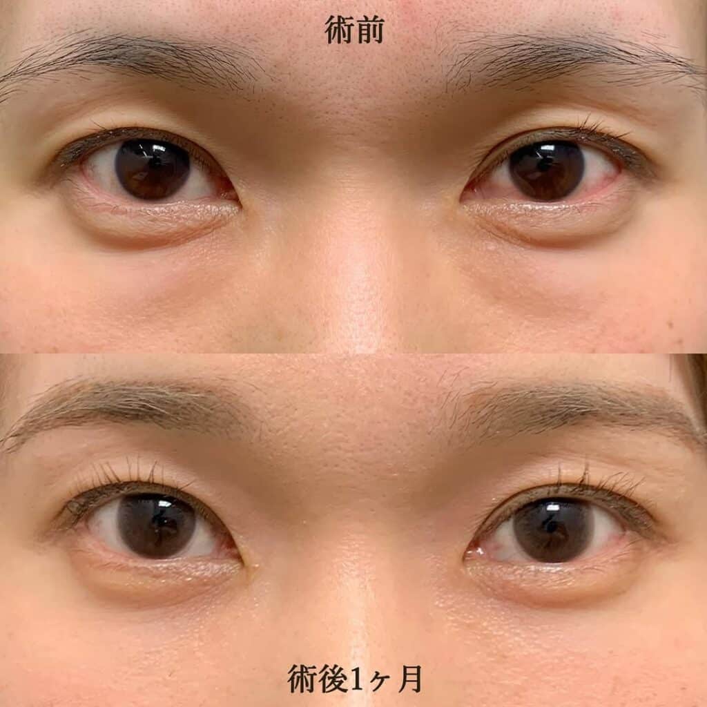 eクリニック大阪院の経結膜脱脂＋脂肪注入