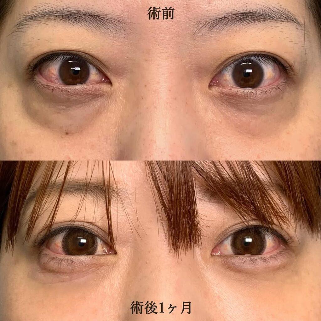 eクリニック大阪院の経結膜脱脂＋脂肪注入