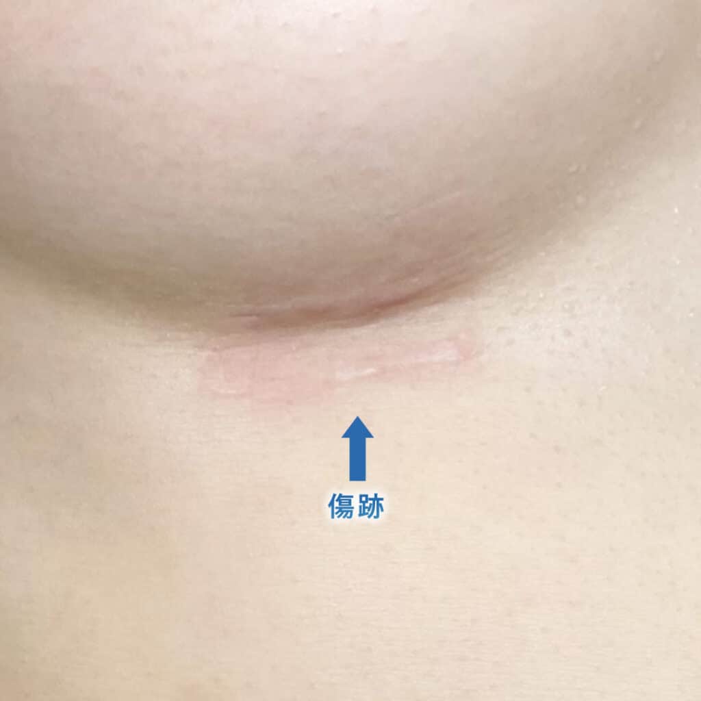 ６ヶ月後の肋軟骨の傷跡