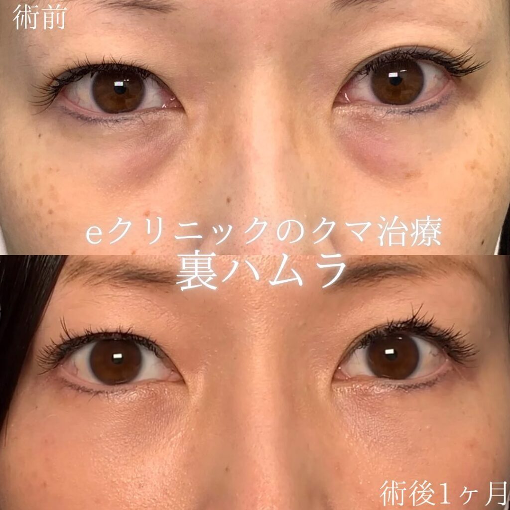 eクリニック大阪院の裏ハムラの症例画像（3）