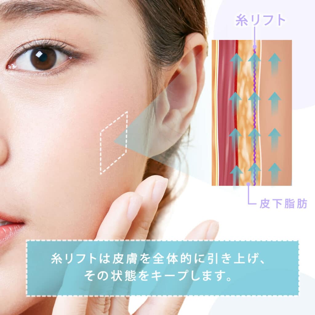 糸リフト