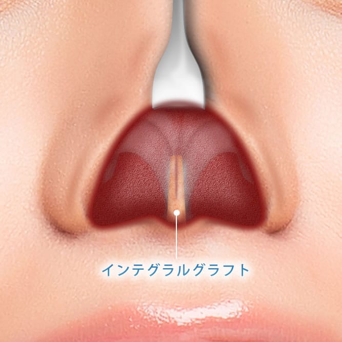 インテグラルグラフトを使った肋軟骨移植の鼻の中の解剖図