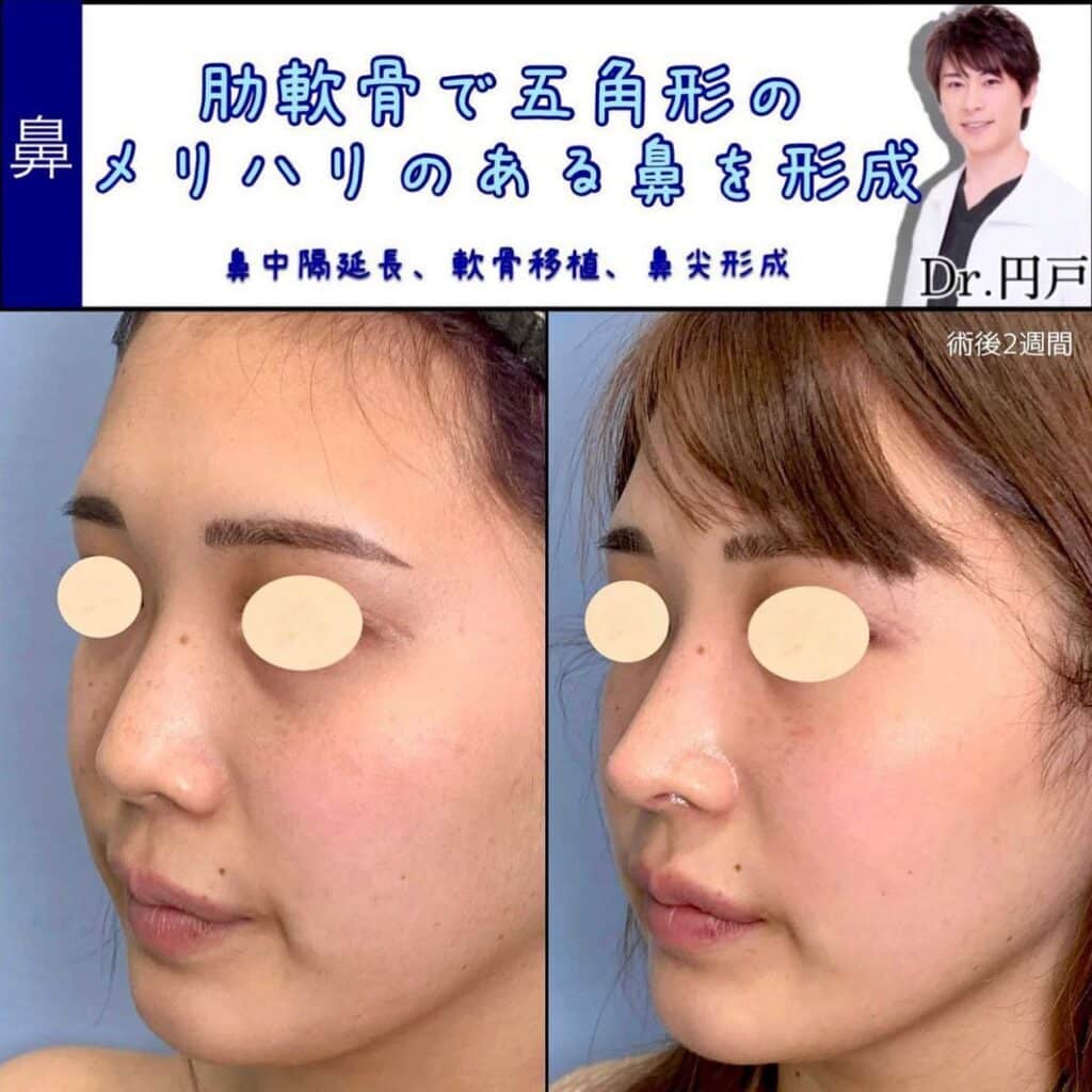 鼻中隔延長と軟骨移植と鼻尖形成の症例写真