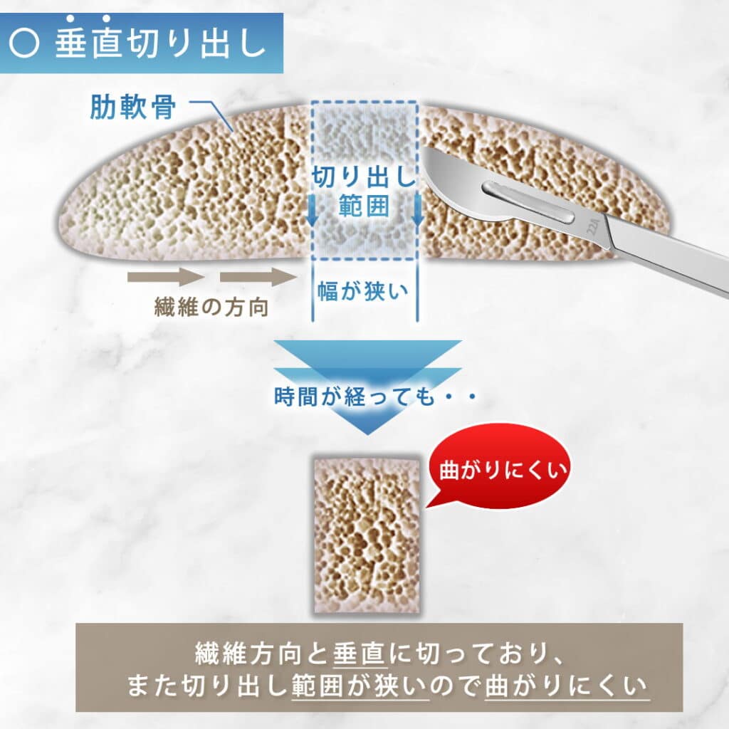 肋軟骨の垂直切り出しの図解