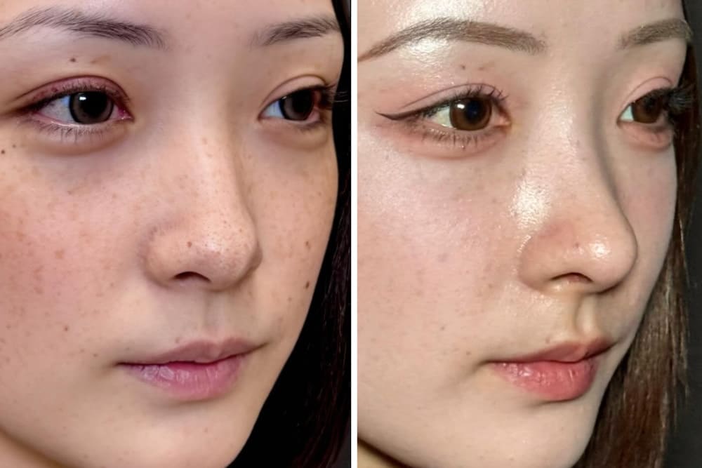 閉鎖式鼻中隔延長の症例写真