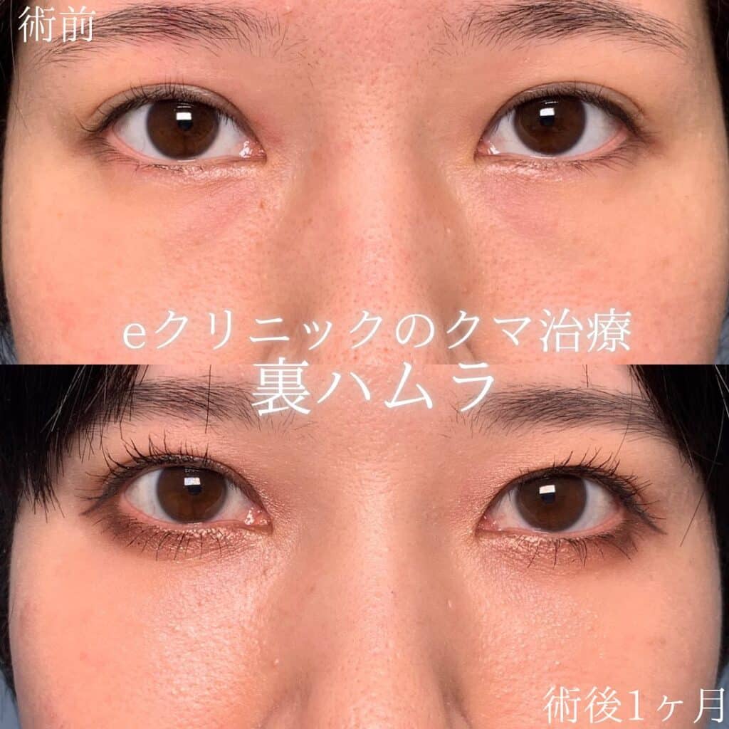eクリニック大阪院の裏ハムラの症例画像（2）