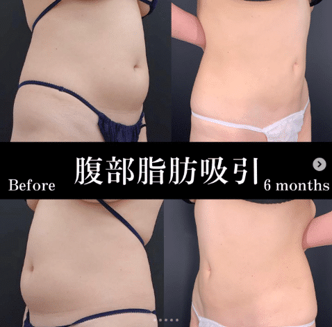 お腹の脂肪吸引