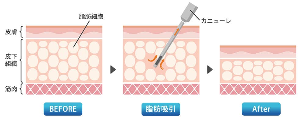 脂肪吸引