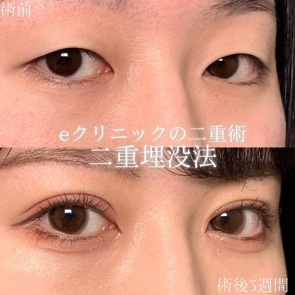名古屋院の埋没法の症例写真 (4)