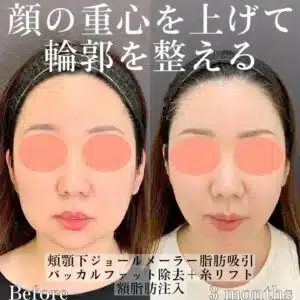 顔脂肪吸引の症例写真