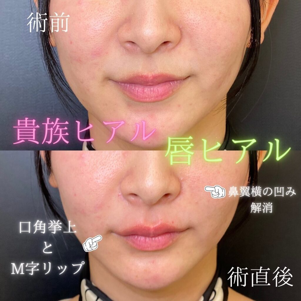 貴族ヒアルロン酸