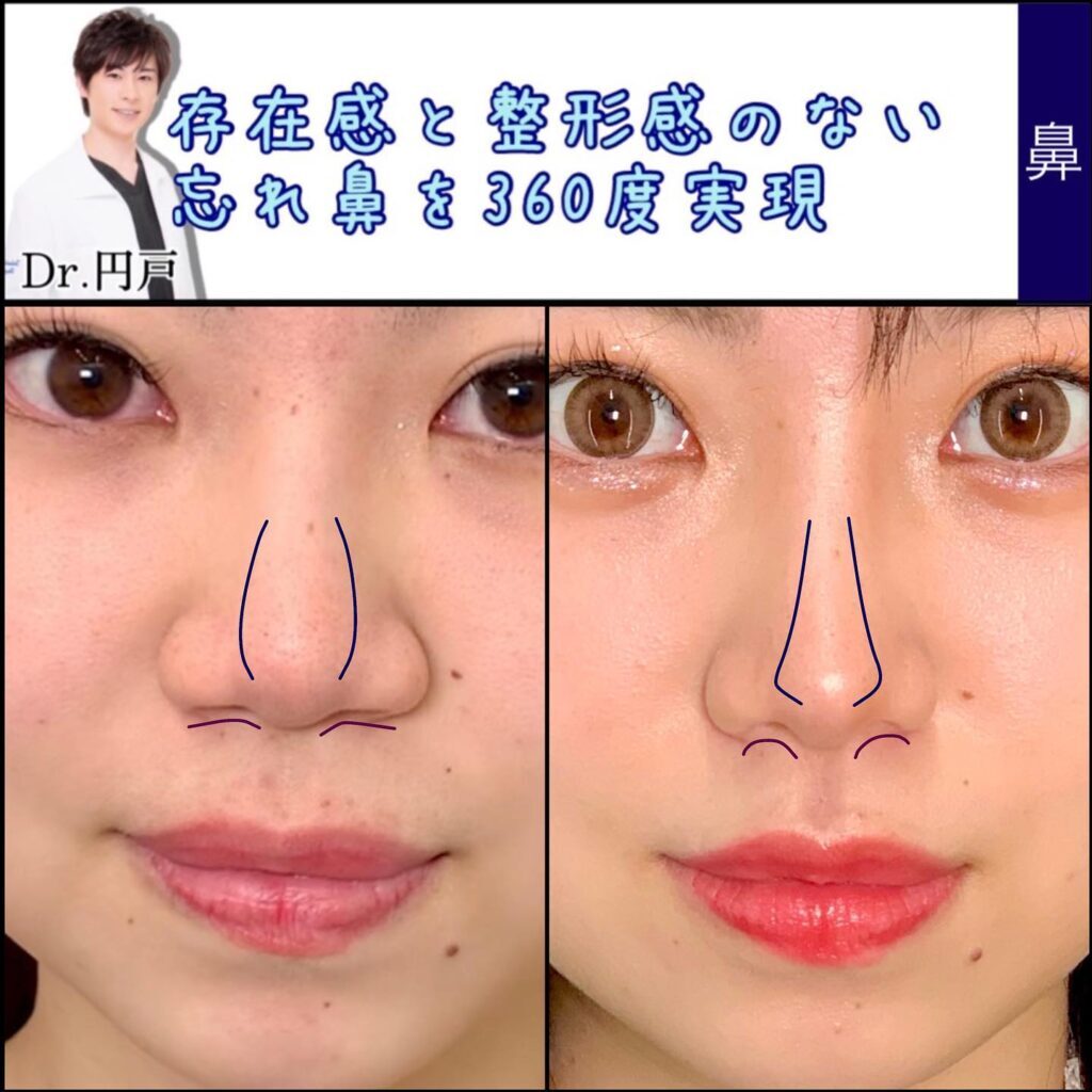 小鼻縮小手術
