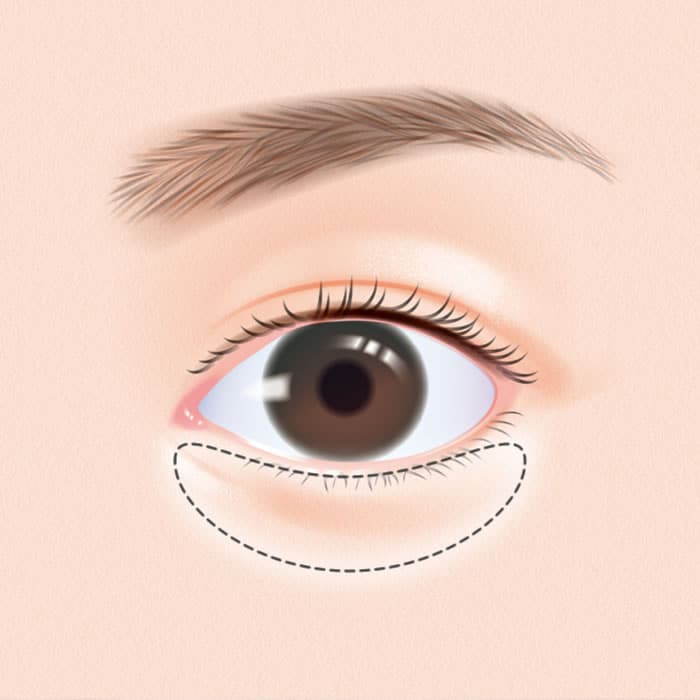 裏ハムラ