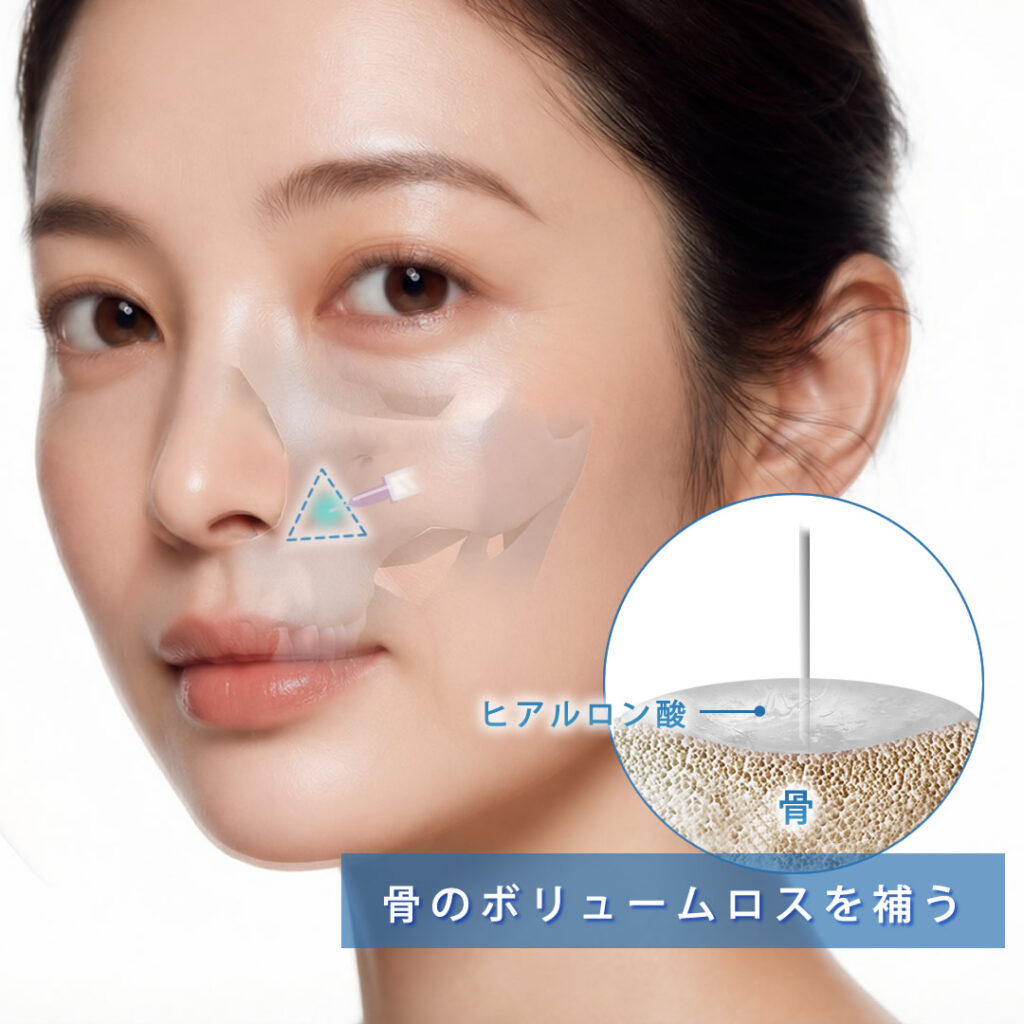 大阪院のほうれい線ヒアルロン酸注射 | eクリニック大阪院【公式