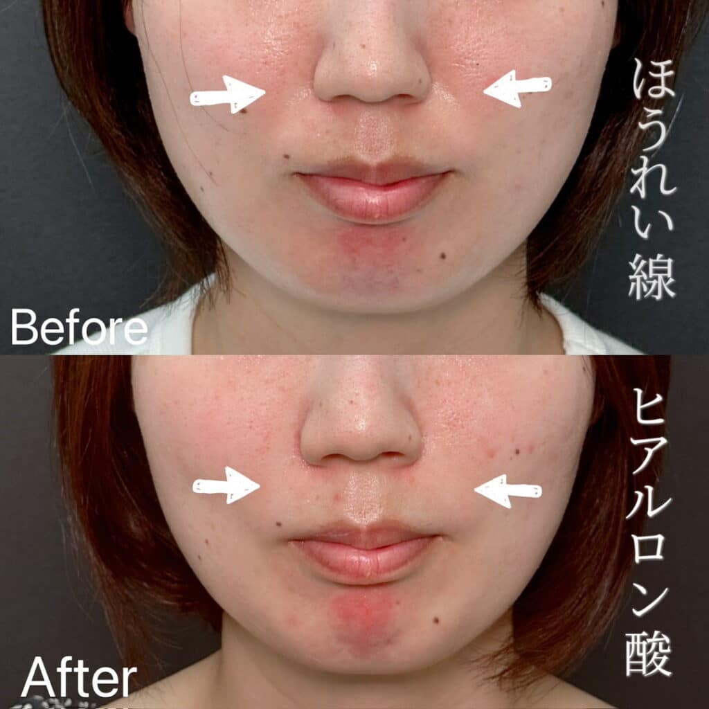 ほうれい線 ヒアルロン酸