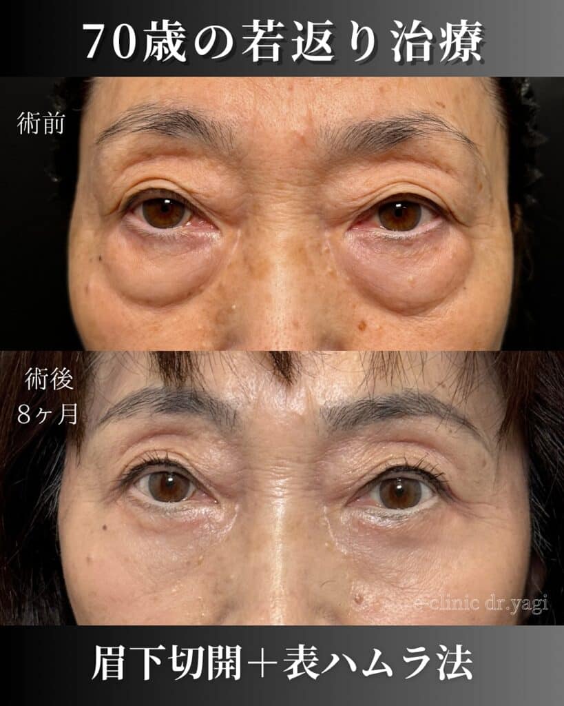 眉下切開の表ハムラ法の症例写真 (2)