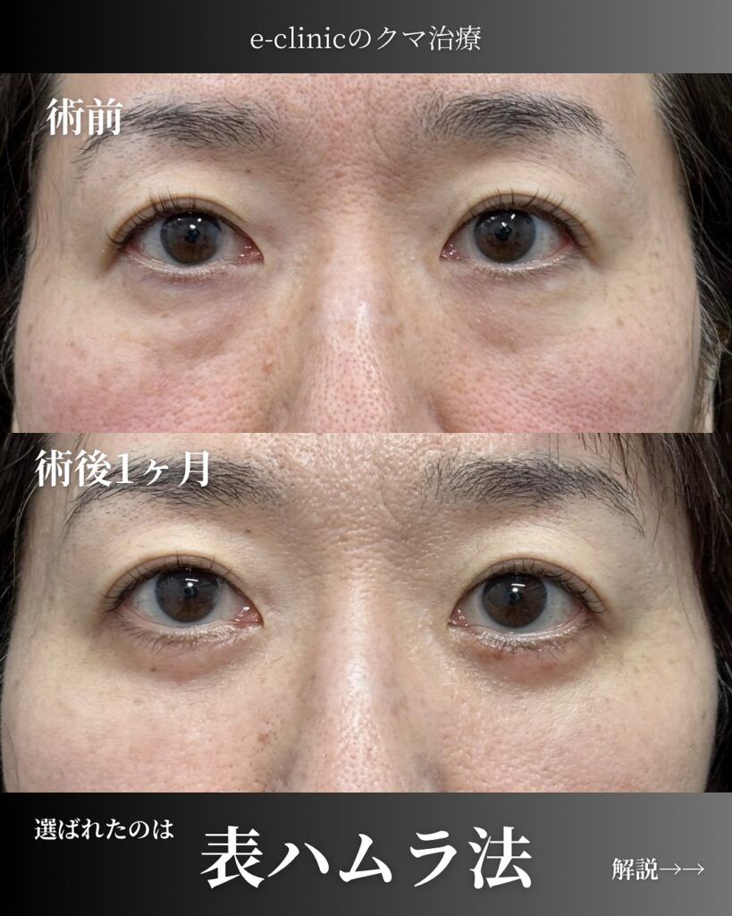 裏ハムラ法の症例写真 (6)