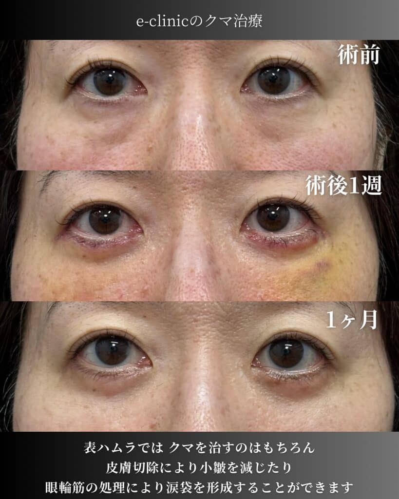 裏ハムラ法の症例写真 (3)