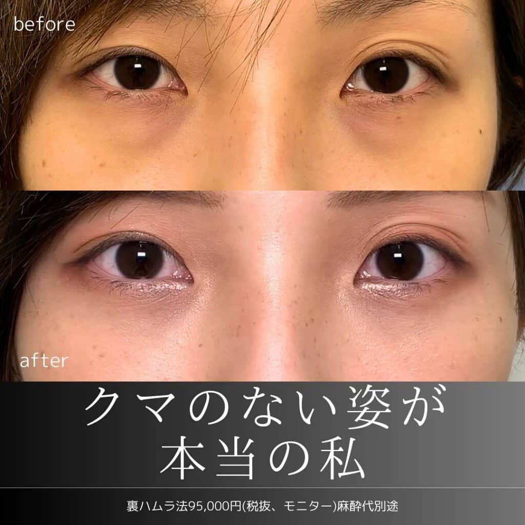 裏ハムラ法を受けた女性の症例写真