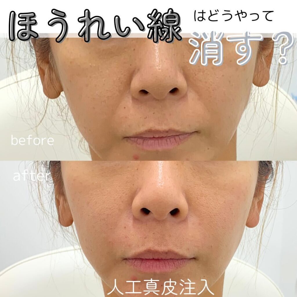 貴族手術
