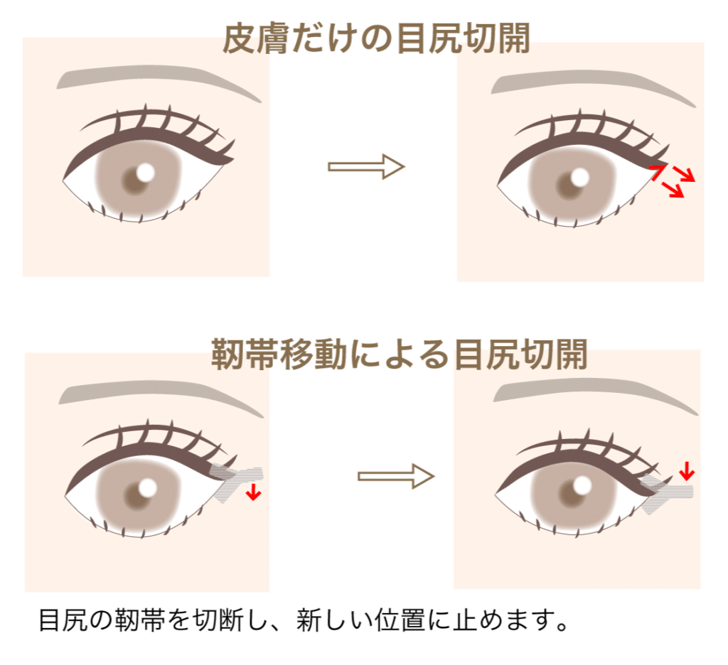 皮膚だけの目尻切開と靭帯移動による目尻切開の図解