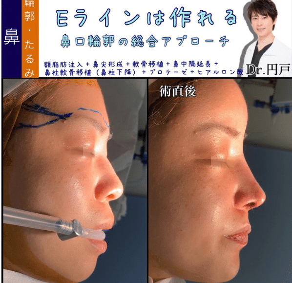 プロテーゼ